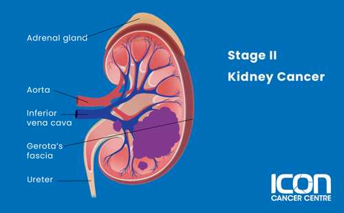 Stage II kidney cancer illustration