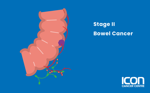 Stage II bowel cancer illustration