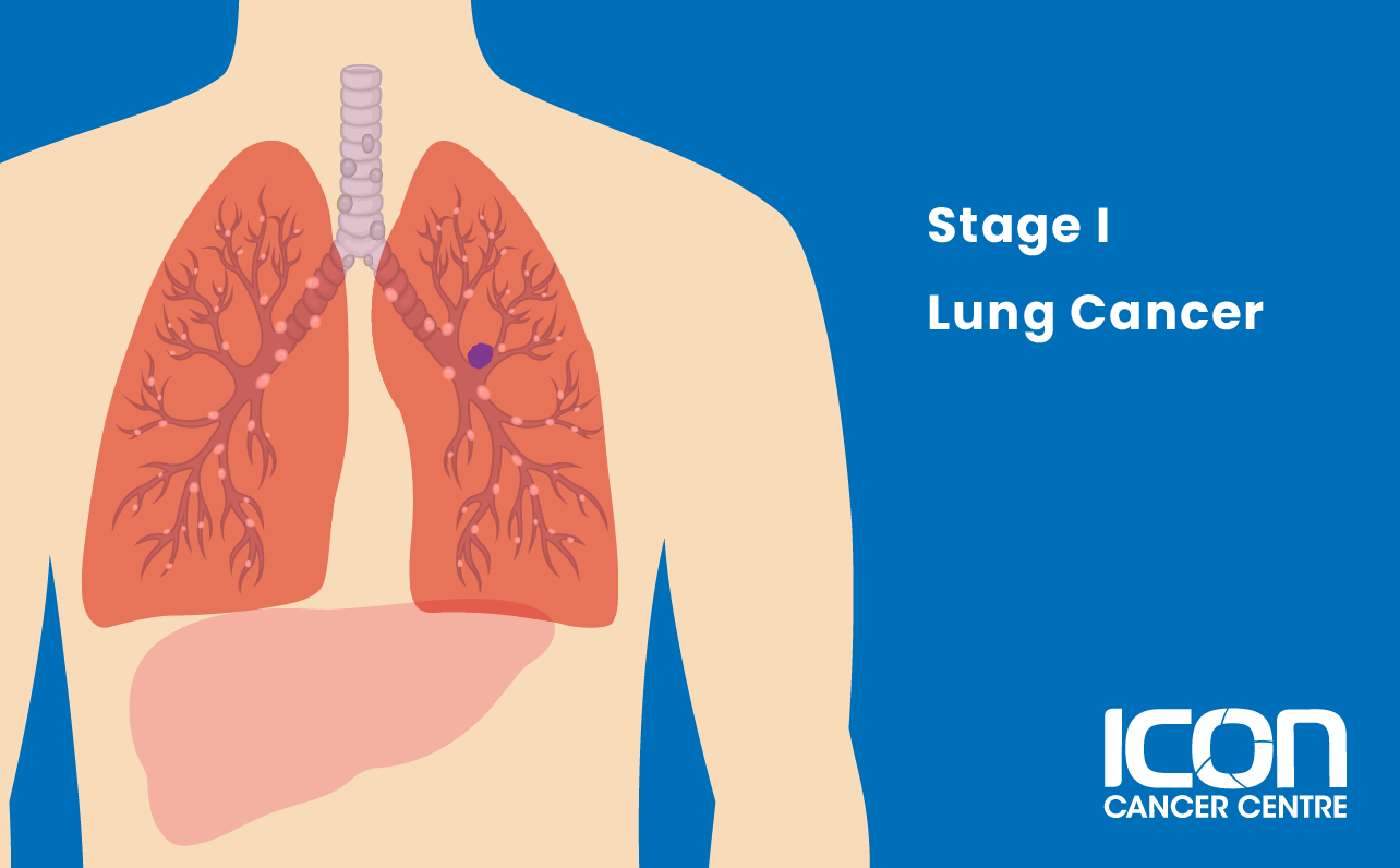 Stage I lung cancer illustration