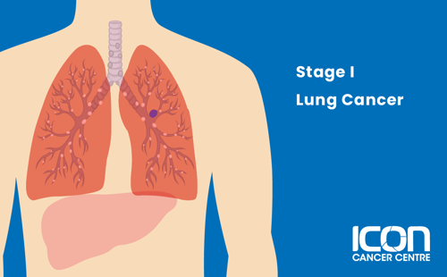 Stage I lung cancer illustration