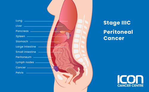 Stage IIIC peritoneal cancer illustration