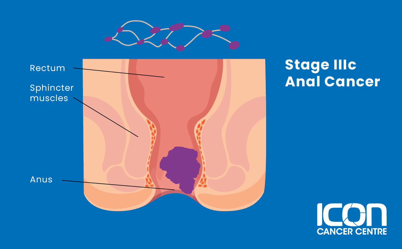 Stage IIIC anal cancer illustration