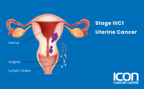 Stage IIIC1 uterine cancer illustration